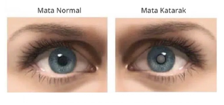 katarak