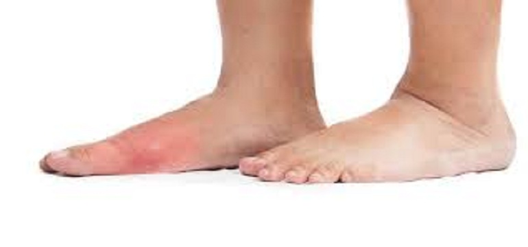 Cara Mengatasi Kaki Bengkak Secara Tiba-tiba