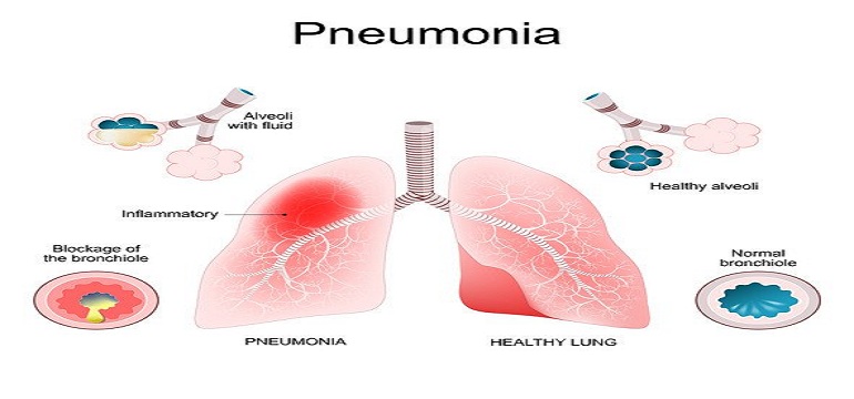 Empat Langkah Pencegahan Pneumonia pada Lansia